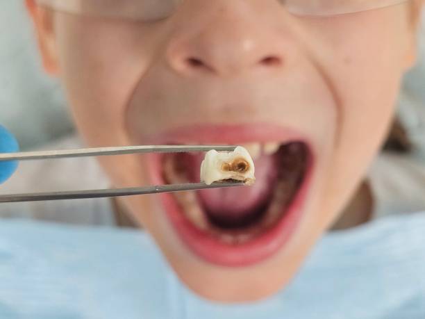 Best Cracked Tooth Emergency Dentist  in Pocomoke City, MD